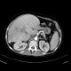 Hereditary hemochromatosis: CT - Computed tomography